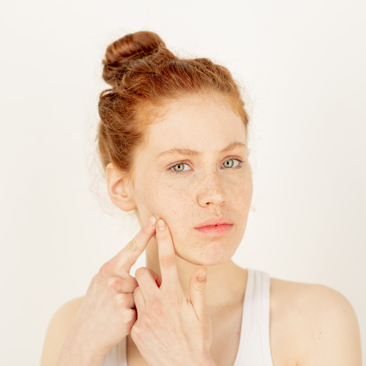 Adult Acne Is On The Rise